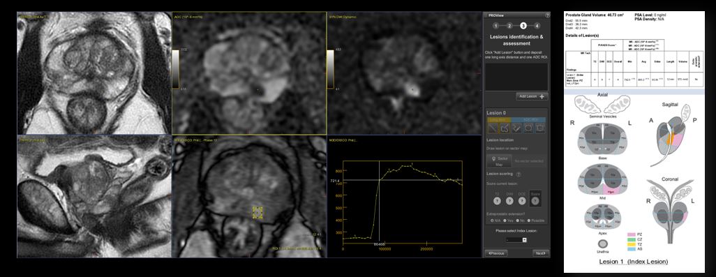 MR Prostate Imaging